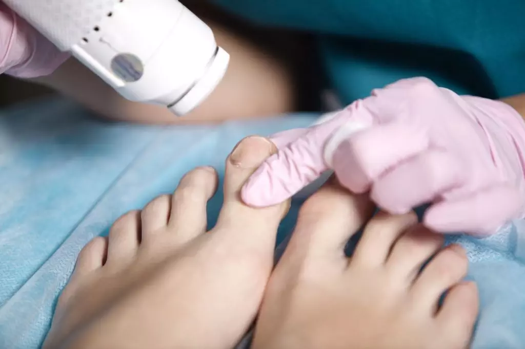 laser-treatment-on-her-feet
